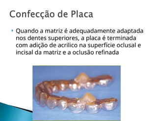  Quando a matriz é adequadamente adaptada
nos dentes superiores, a placa é terminada
com adição de acrilico na superfície oclusal e
incisal da matriz e a oclusão refinada
 