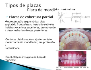  Placas de cobertura parcial
•Representação esquemática, vista
sagital,do front-plateau instalado sobre os
incisivos e caninos superiores, promovendo
a desoclusão dos dentes posteriores.
•Contatos obtidos após o ajuste: contato
•no fechamento mandibular, em protrusão
e
•lateralidade.
•Front-Plateau instalado na boca do
•paciente.
Placa de mordida anterior
 