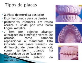  2. Placa de mordida posterior
 É confeccionada para os dentes
 posteriores inferiores, em resina
acrílica e unida por uma barra
lingual metálica
 . Tem por objetivo alcançar
alterações na dimensão vertical de
oclusão, como também
reposicionar a mandíbula. Está
indicada nos casos severos de
diminuição de dimensão vertical,
como também quando há
necessidade de se fazer um
 reposicionamento anterior da
mandíbula
 