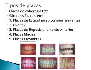  Placas de cobertura total
 São classificadas em:
 1. Placas de Estabilização ou miorrelaxantes
 2. Overlay
 3. Placas de Reposicionamento Anterior
 4. Placas Macias
 5. Placas Pivotantes
 