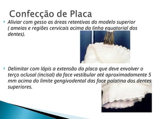  Aliviar com gesso as áreas retentivas do modelo superior
( ameias e regiões cervicais acima da linha equatorial dos
dentes).
 Delimitar com lápis a extensão da placa que deve envolver o
terço oclusal (incisal) da face vestibular até aproximadamente 5
mm acima do limite gengivodental das face palatina dos dentes
superiores.
 