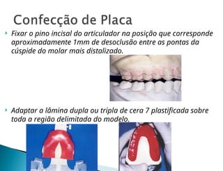  Fixar o pino incisal do articulador na posição que corresponde
aproximadamente 1mm de desoclusão entre as pontas da
cúspide do molar mais distalizado.
 Adaptar a lâmina dupla ou tripla de cera 7 plastificada sobre
toda a região delimitada do modelo.
 