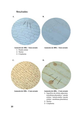 20
Resultados:
A. B.
Aumento de 100x – Sem corante
1- Parede celular
2- Núcleo
3- Citoplasma
Aumento de 400x – Sem corante
C. D.
Aumento de 100x – Com corante Aumento de 400x – Com corante
1- Superfície de células adjacentes
(membrana plasmática + parede
celular + lamela média+ parede
celular+ membrana plasmática)
2- Núcleo
3- Citoplasma
 