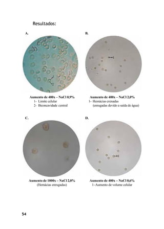 54
Resultados:
A. B.
Aumento de 400x – NaCl 0,9%
1- Limite celular
2- Biconcavidade central
Aumento de 400x – NaCl 2,0%
1- Hemácias crenadas
(enrugadas devido a saída de água)
C. D.
Aumento de 1000x – NaCl 2,0%
(Hemácias enrugadas)
Aumento de 400x – NaCl 0,6%
1-Aumento de volume celular
 