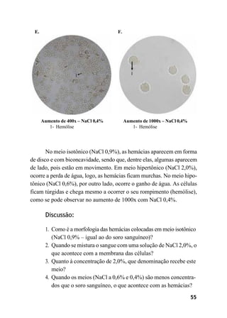 55
E. F.
Aumento de 400x – NaCl 0,4%
1- Hemólise
Aumento de 1000x – NaCl 0,4%
1- Hemólise
No meio isotônico (NaCl 0,9%), as hemácias aparecem em forma
de disco e com biconcavidade, sendo que, dentre elas, algumas aparecem
de lado, pois estão em movimento. Em meio hipertônico (NaCl 2,0%),
ocorre a perda de água, logo, as hemácias ficam murchas. No meio hipo-
tônico (NaCl 0,6%), por outro lado, ocorre o ganho de água. As células
ficam túrgidas e chega mesmo a ocorrer o seu rompimento (hemólise),
como se pode observar no aumento de 1000x com NaCl 0,4%.
Discussão:
1. Como é a morfologia das hemácias colocadas em meio isotônico
(NaCl 0,9% – igual ao do soro sanguíneo)?
2. Quando se mistura o sangue com uma solução de NaCl 2,0%, o
que acontece com a membrana das células?
3. Quanto à concentração de 2,0%, que denominação recebe este
meio?
4. Quando os meios (NaCl a 0,6% e 0,4%) são menos concentra-
dos que o soro sanguíneo, o que acontece com as hemácias?
 