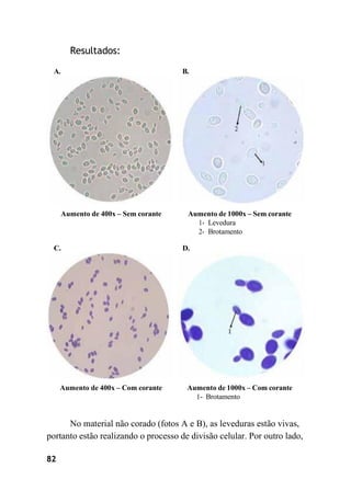 82
Resultados:
A. B.
Aumento de 400x – Sem corante Aumento de 1000x – Sem corante
1- Levedura
2- Brotamento
C. D.
Aumento de 400x – Com corante Aumento de 1000x – Com corante
1- Brotamento
No material não corado (fotos A e B), as leveduras estão vivas,
portanto estão realizando o processo de divisão celular. Por outro lado,
 