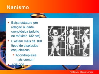 Nanismo Baixa estatura em relação à idade cronológica (adulto no máximo 132 cm) Existem mais de 100 tipos de displasias esqueléticas Acondroplasia  mais comum 1:25.000 