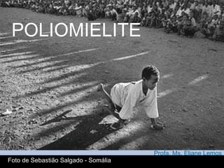 POLIOMIELITE Profa. Ms. Eliane Lemos Foto de Sebastião Salgado - Somália 