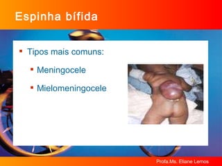 Espinha bífida Tipos mais comuns: Meningocele Mielomeningocele 