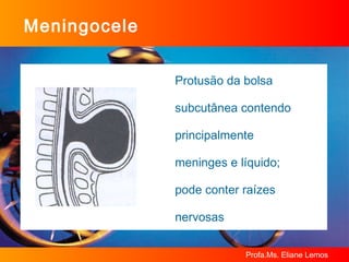 Meningocele Protusão da bolsa  subcutânea contendo  principalmente  meninges e líquido;  pode conter raízes  nervosas 