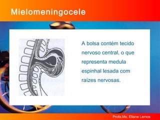 Mielomeningocele A bolsa contém tecido  nervoso central, o que  representa medula  espinhal lesada com  raízes nervosas. 