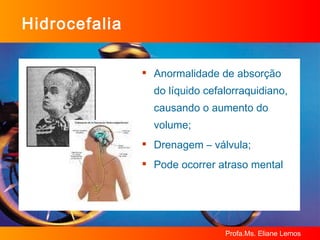 Hidrocefalia Anormalidade de absorção  do líquido cefalorraquidiano, causando o aumento do volume; Drenagem – válvula; Pode ocorrer atraso mental 