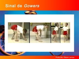 Sinal de  Gowers 