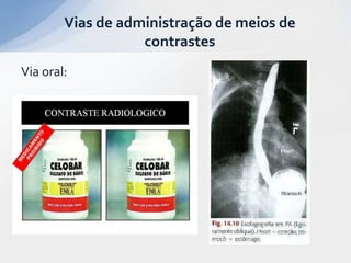 Via oral:
Vias de administração de meios de
contrastes
 
