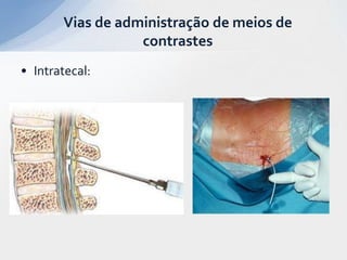 • Intratecal:
Vias de administração de meios de
contrastes
 