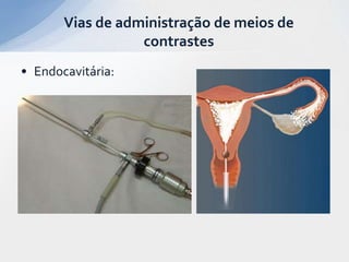 • Endocavitária:
Vias de administração de meios de
contrastes
 