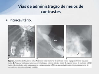 • Intracavitário:
Vias de administração de meios de
contrastes
 