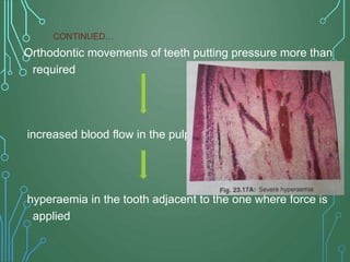 Orthodontic movements of teeth putting pressure more than
required
increased blood flow in the pulp
hyperaemia in the tooth adjacent to the one where force is
applied
CONTINUED…
 