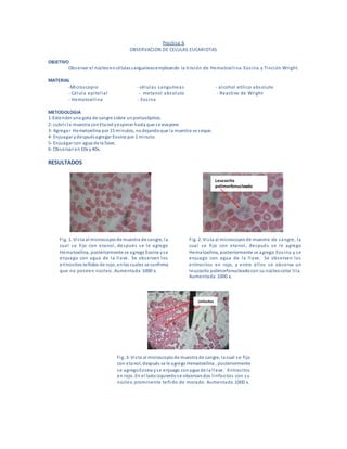 Practica 6
OBSERVACION DE CELULAS EUCARIOTAS
OBJETIVO
Observar el núcleoencélulassanguíneasempleando la tinción de Hematoxilina-Eosina y Tinción Wright.
MATERIAL
-Microscopio - células sanguíneas - alcohol etílico absoluto
- Célula epitelial - metanol absoluto - Reactivo de Wright
- Hematoxilina - Eosina
METODOLOGIA
1-Extender una gota de sangre sobre unportaobjetos.
2- cubrir la muestra conEtanol yesperar hasta que se evapore.
3- Agregar Hematoxilina por 15 minutos, nodejandoque la muestra se seque.
4- Enjuagar ydespuésagregar Eosina por 1 minuto.
5- Enjuagar con agua de la llave.
6- Observar en10x y40x.
RESULTADOS
Fig. 1. Vista al microscopiode muestra de sangre, la
cual se fijo con etanol, después se le agrego
Hematoxilina, posteriormente se agrego Eosina yse
enjuago con agua de la llave. Se observan los
eritrocitos teñidos de rojo, enlos cuales se confirma
que no poseen núcleo. Aumentada 1000 x.
Fig. 2. Vista al microscopiode muestra de sangre, la
cual se fijo con etanol, después se le agrego
Hematoxilina, posteriormente se agrego Eosina y se
enjuago con agua de la llave. Se observan los
eritrocitos en rojo, y entre ellos se observa un
leucocito polimorfonucleadocon su núcleocolor lila.
Aumentada 1000 x.
Leucocito
polimorfonucleado
Fig. 3. Vista al microscopiode muestra de sangre, la cual se fijo
con etanol, después se le agrego Hematoxilina , posteriormente
se agregoEosina yse enjuago conagua de la llave. Eritrocitos
en rojo. En el ladoizquierdose observandos linfocitos con su
núcleo prominente teñido de morado. Aumentado 1000 x.
Linfositos
 