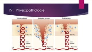 IV. Physiopathologie
 
