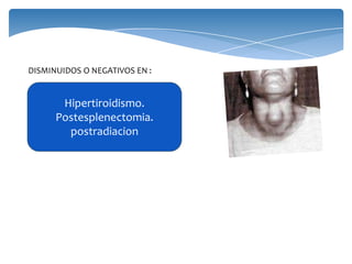 DISMINUIDOS O NEGATIVOS EN :
Hipertiroidismo.
Postesplenectomia.
postradiacion
 