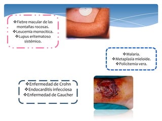 Malaria.
Metaplasia mieloide.
Policitemia vera.
Fiebre macular de las
montañas rocosas.
Leucemia monocitica.
Lupus eritematoso
sistémico.
Enfermedad de Crohn
Endocarditis infecciosa
Enfermedad de Gaucher
 