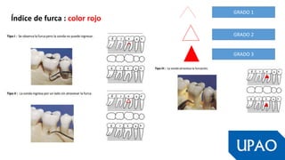 Índice de furca : color rojo
GRADO 1
GRADO 3
GRADO 2
 