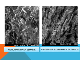 HIDROXIAPATITA EN ESMALTE CRISTALES DE FLUOROAPATITA EN ESMALTE
 