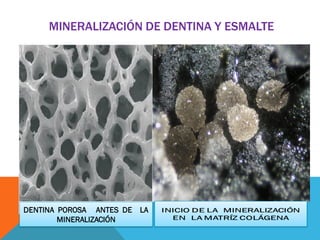 DENTINA POROSA ANTES DE LA
MINERALIZACIÓN
MINERALIZACIÓN DE DENTINA Y ESMALTE
 