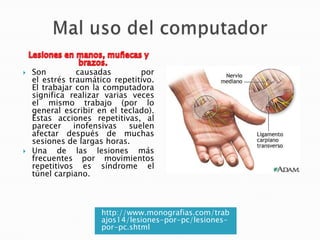 



Son
causadas
por
el estrés traumático repetitivo.
El trabajar con la computadora
significa realizar varias veces
el mismo trabajo (por lo
general escribir en el teclado).
Estas acciones repetitivas, al
parecer
inofensivas
suelen
afectar después de muchas
sesiones de largas horas.
Una de las lesiones más
frecuentes por movimientos
repetitivos es síndrome el
túnel carpiano.

http://www.monografias.com/trab
ajos14/lesiones-por-pc/lesionespor-pc.shtml

 