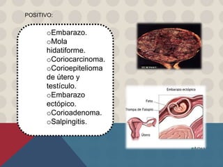 oEmbarazo.
oMola
hidatiforme.
oCoriocarcinoma.
oCorioepitelioma
de útero y
testículo.
oEmbarazo
ectópico.
oCorioadenoma.
oSalpingitis.
POSITIVO:
 