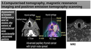3.Computerised tomography, magnetic resonance
imaging and positron emission tomography scanning
Assessment
of known
malignancy
and to
assess the
extent of
retrosternal
and,
occasionally
,recurrent
goitres
MRI
 