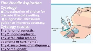 Fine Needle Aspiration
Cytology
■ Investigation of choice for
discrete thyroid swelling.
■ Diagnostic Ultrasound
guidance improves accuracy.
Cytology results:
Thy 1: non-diagnostic.
Thy 2 : non-neoplastic.
Thy 3: follicular (can be
adenoma or carcinoma).
Thy 4: suspicious of malignancy.
Thy 5: malignant.
 