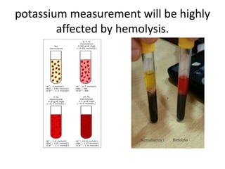 potassium measurement will be highly
affected by hemolysis.
 