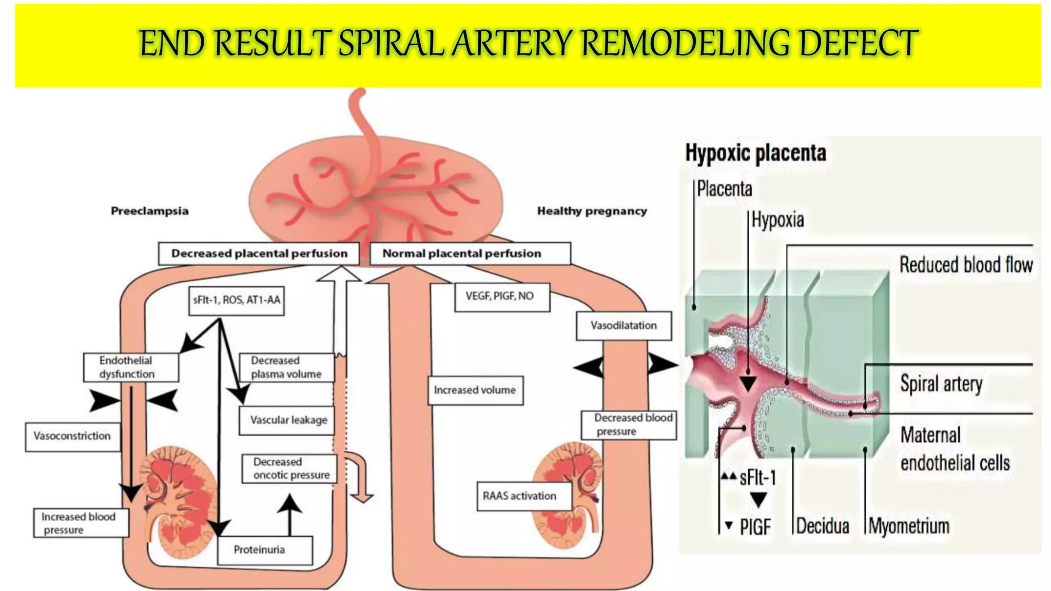 pathogenesis of Pre eclampsia | PPTX