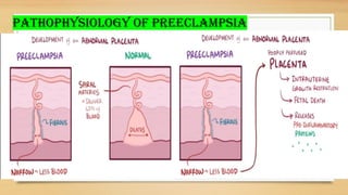 PATHOPHYSIOLOGY OF PREECLAMPSIA
 