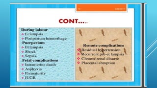Pre eclampsia | PPTX