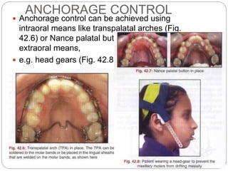 ANCHORAGE CONTROL
 Anchorage control can be achieved using
intraoral means like transpalatal arches (Fig.
42.6) or Nance palatal button (Fig. 42.7) etc. or
extraoral means,
 e.g. head gears (Fig. 42.8).
 