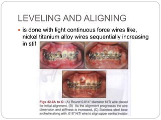 LEVELlNG AND ALIGNING
 is done with light continuous force wires like,
nickel titanium alloy wires sequentially increasing
in stiffness and diameter
 