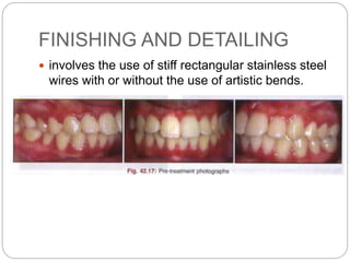 FINISHING AND DETAILING
 involves the use of stiff rectangular stainless steel
wires with or without the use of artistic bends.
 