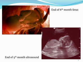 11
End of 5th month ultrasound
End of 6th month fetus
 