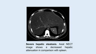 Severe hepatic steatosis. Axial NECT
image shows a decreased hepatic
attenuation in comparison with spleen.
 