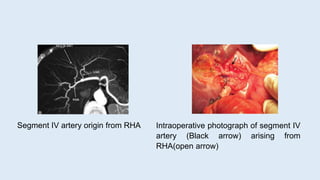 Segment IV artery origin from RHA Intraoperative photograph of segment IV
artery (Black arrow) arising from
RHA(open arrow)
 