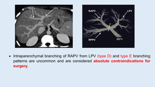  Intraparenchymal branching of RAPV from LPV (type D) and type E branching
patterns are uncommon and are considered absolute contraindications for
surgery.
 