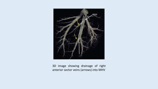 3D image showing drainage of right
anterior sector veins (arrows) into MHV
 