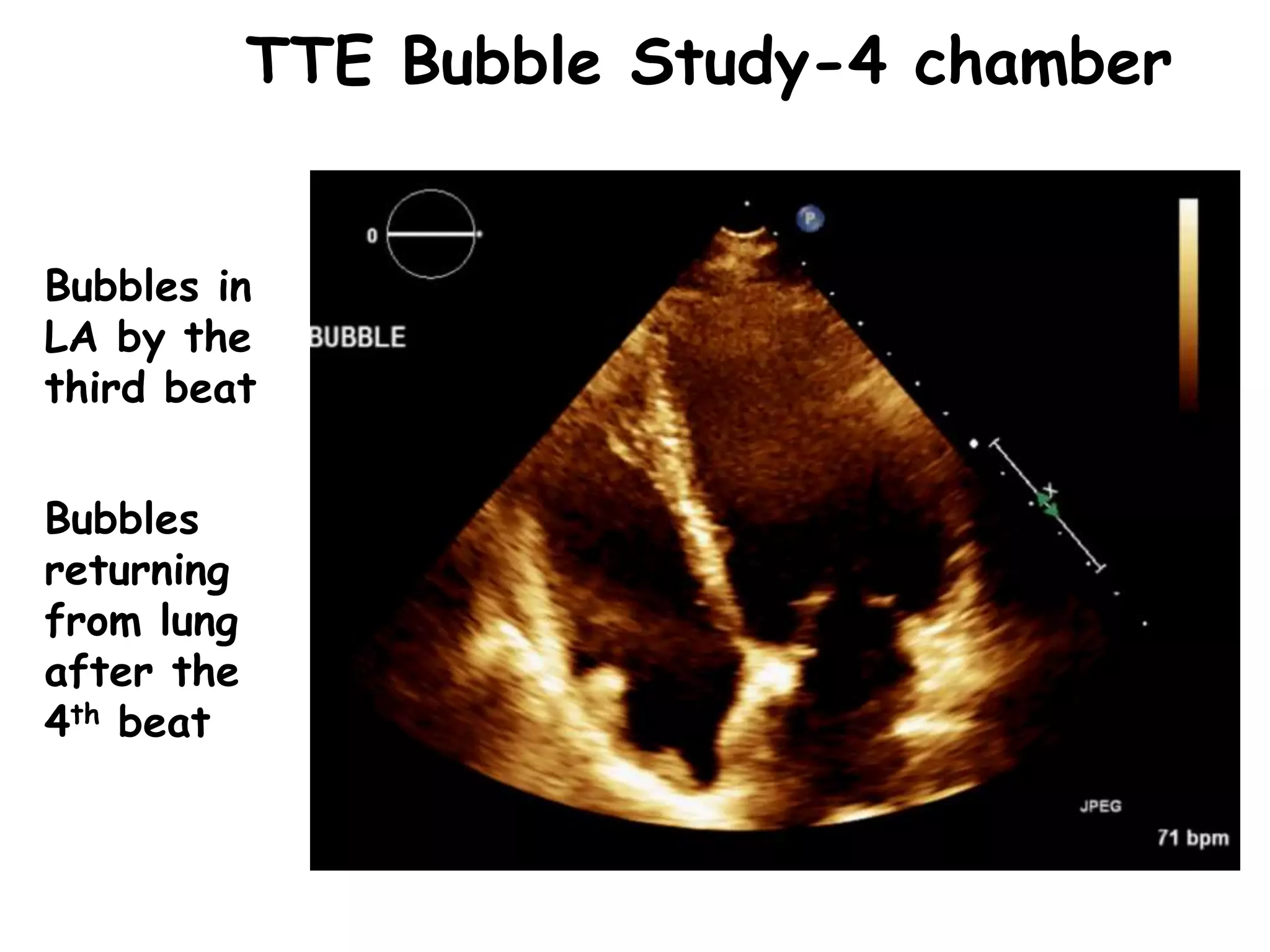 TTE Bubble Study-4 chamber
Bubbles in
LA by the
third beat
Bubbles
returning
from lung
after the
4th beat
 