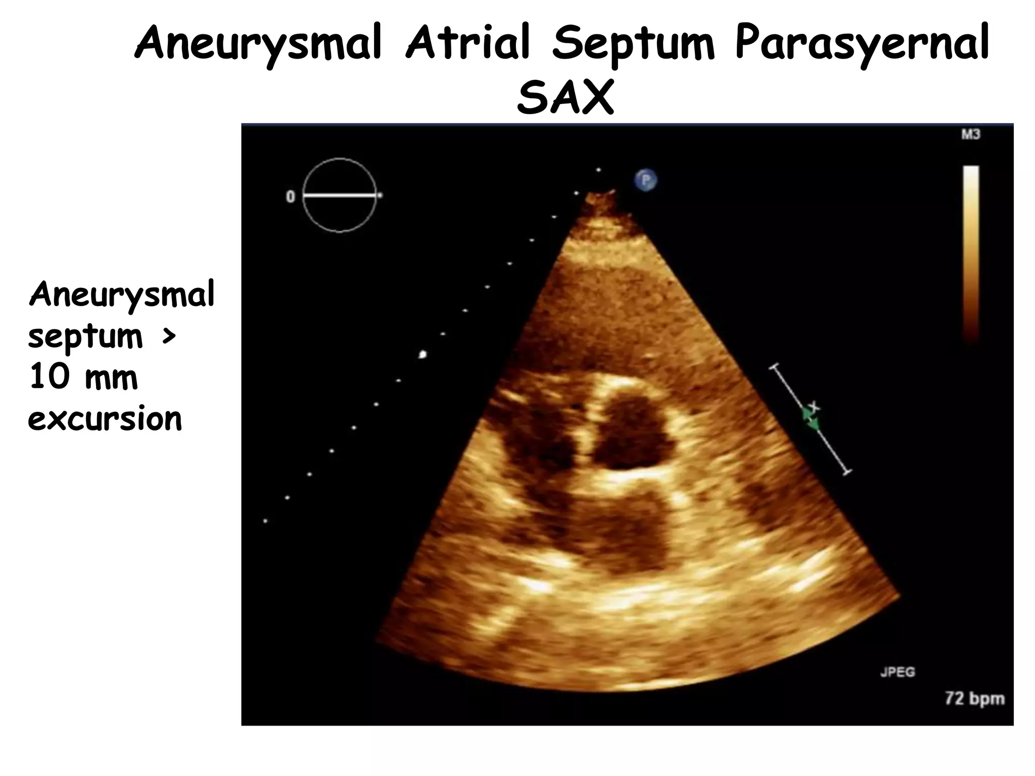 Aneurysmal Atrial Septum Parasyernal
SAX
Aneurysmal
septum >
10 mm
excursion
 