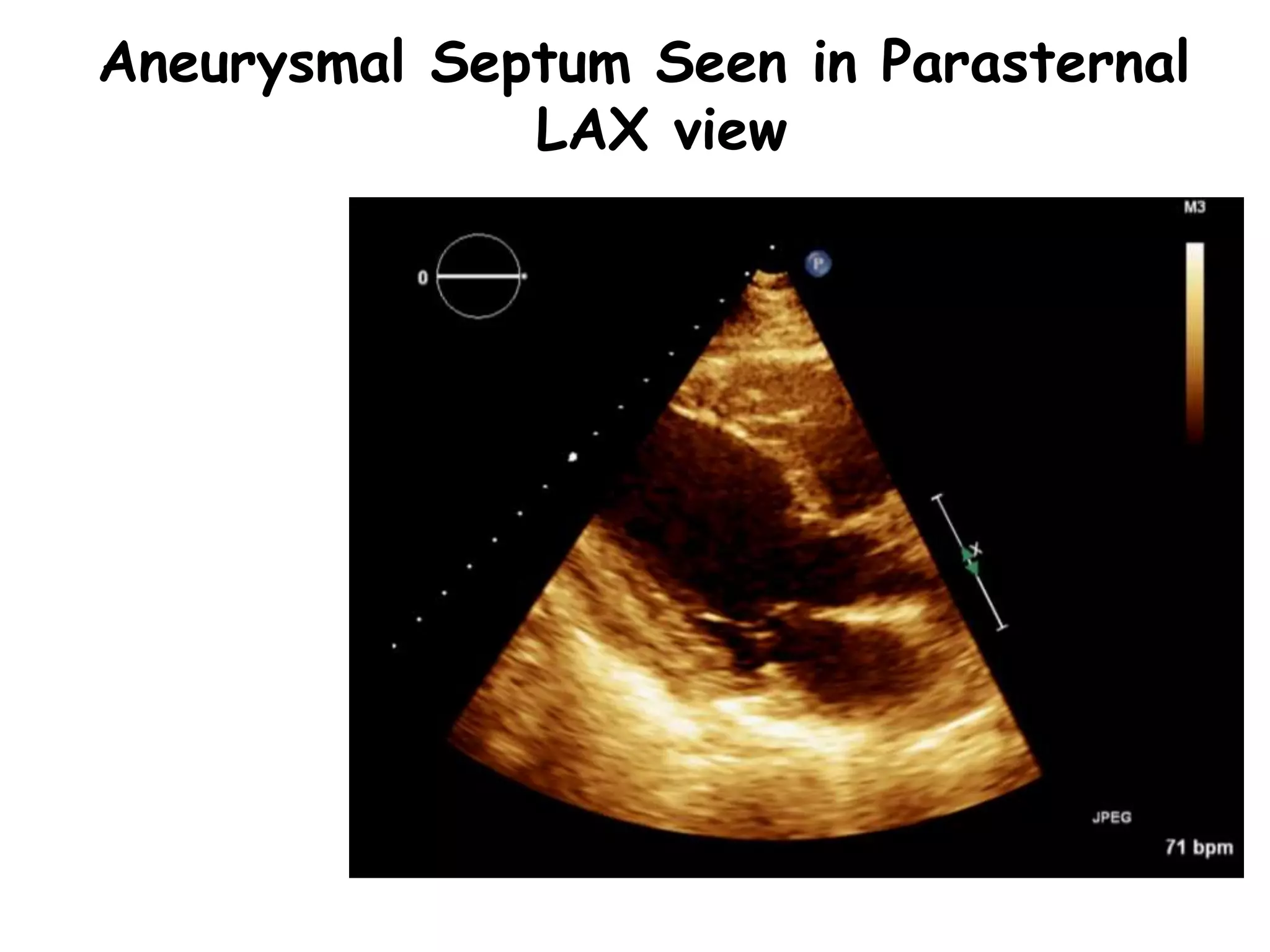 Aneurysmal Septum Seen in Parasternal
LAX view
 