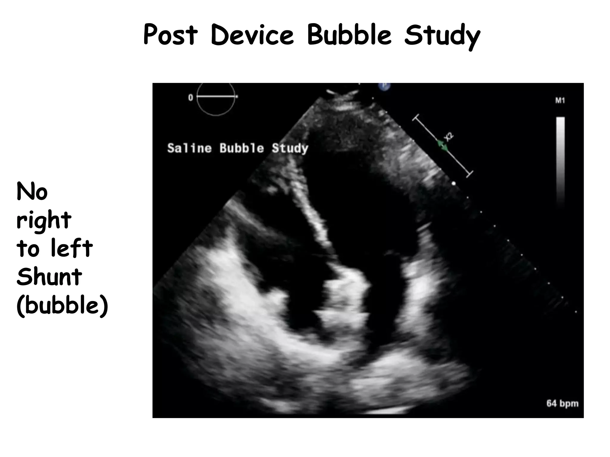 Post Device Bubble Study
No
right
to left
Shunt
(bubble)
 