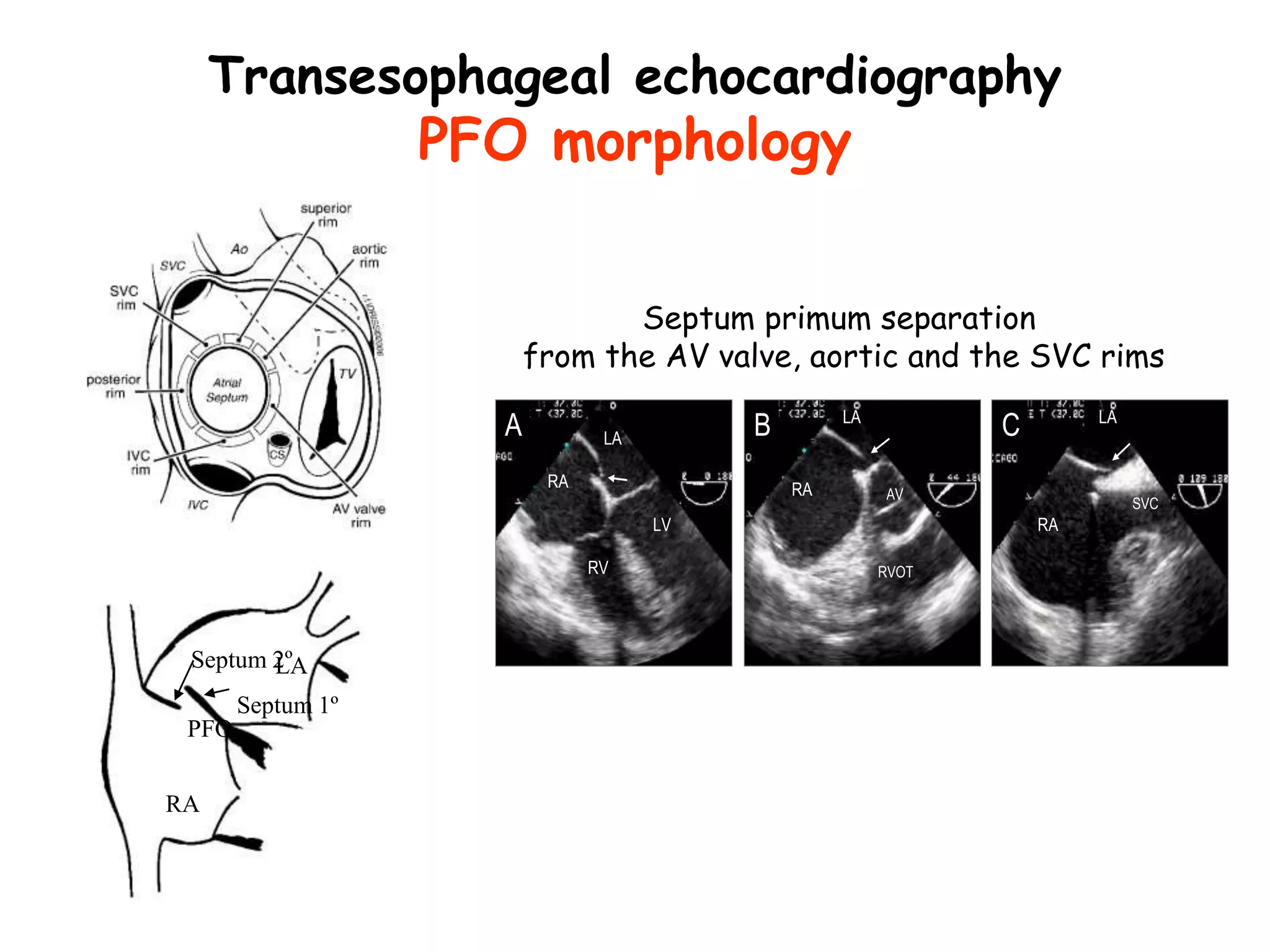 Transesophageal echocardiography
PFO morphology
A LA
RA
LV
RV
B LA
RA AV
RVOT
C LA
RA
SVC
RA
LA
PFO
Septum 1º
Septum 2º
Septum primum separation
from the AV valve, aortic and the SVC rims
 